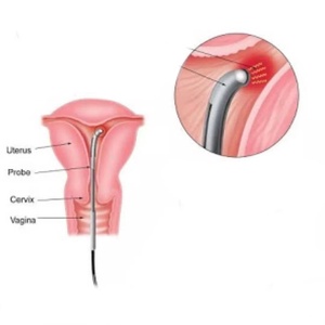 Macchina Chirurgica per Proctologia e Emorroidectomia 1470nm 980nm 3000ms per Taglio Emorroidi e Fistole Anali, Fibra Conica Anorettale - Product Image 6
