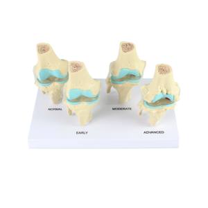 Modèle d'articulation du genou, anatomie humaine, modèle de genou pour l'enseignement de la pathologie, 4 étapes - Product Image 6