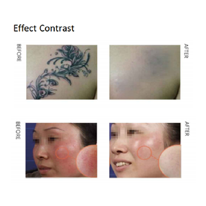 Dispositivo de Gestión de la Piel Diamond Super Photon DPL de Plástico para Rejuvenecimiento de la Piel y Depilación Antienvejecimiento, Equipo de Salón de Belleza - Product Image 3