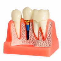 Modèle d'implant dentaire pédagogique, modèle détachable de couronne dentaire et de visqueuse pour la formation des dentistes et l'affichage en clinique