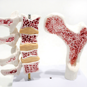Modelo de Hueso de Osteoporosis, Modelo Anatómico de Esqueleto Humano en PVC para Escuelas - Vic <span class=keywords><strong>Science</strong></span> VIC-V45 - Product Image 1