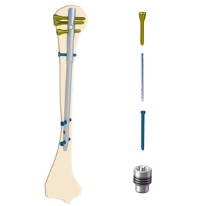 Set di combinazione per unghie intramidollari multidimensionali in lega di titanio professionale Set impianto per omerale - Product Image 6