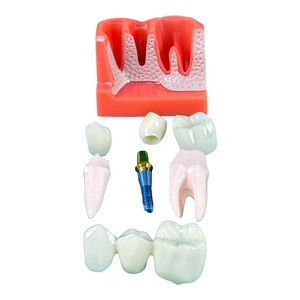 Modelo Dental MAXCARE MAC-L30 con Ampliación 6x y Implante para Enseñanza y Práctica Médica - Product Image 4