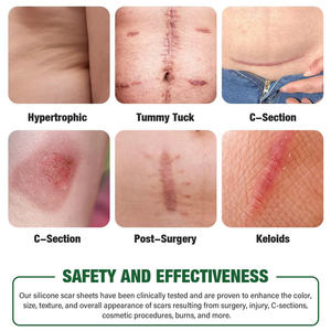 สติ้กเกอร์ซิลิโคนรอยแผลเป็นมีกาวในตัวมาส์กหน้า<span class=keywords><strong>เนื้อ</strong></span>สีกันน้ำสำหรับถอดได้1.5เมตร - Product Image 4