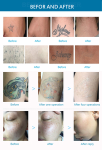 Máquina Portátil de Eliminación de Tatuajes con Láser de Picosegundos, Eliminación de Pigmentos, Peeling de Carbón, Blanqueamiento, Cepillo de Limpieza Facial - Product Image 5
