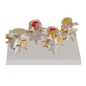 Gelsonlab HSBM-134 4 Stadiumwervels Menselijk Anatomisch Model Lendenwervel Wervel Zieke Osteoporose Wervels Model - Product Image 5