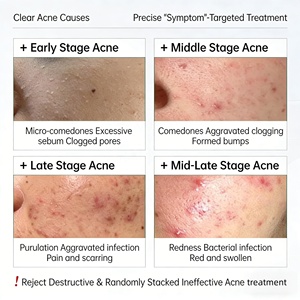 Crème Hydratante Traitement Acné Kystique En Gros OEM Élimination <span class=keywords><strong>Boutons</strong></span> Anti-Imperfections et Anti-Acné Produits - Product Image 3