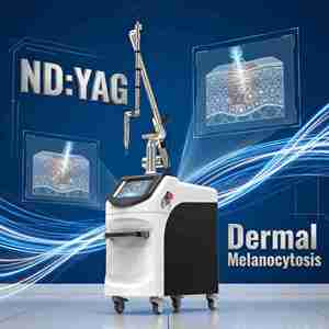 Macchina Laser Q-Switched Nd:YAG 1064nm 532nm, Attrezzatura Professionale per Rimozione Tatuaggi, Laser Picosecondo ND:YAG per Peeling al Carbonio - Product Image 1
