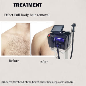 Machine portative d'épilation de diode de 808 755 1064 pour la clinique de <span class=keywords><strong>salon</strong></span> de beauté - Product Image 5