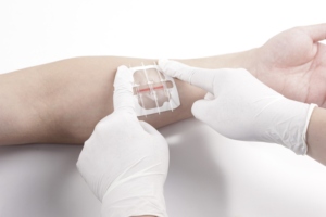 Dispositivo de cierre de piel de herida resistente a bacterias <span class=keywords><strong>con</strong></span> certificado CE médico desechable tiras transparentes sin costuras autoadhesivas estériles - Product Image 4