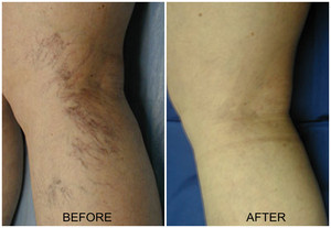 جهاز متعدد الوظائف بتقنية الليزر 980 نانومتر لإزالة فطريات الأظافر وتخفيف الألم وإزالة الأوردة العنكبوتية - Product Image 3