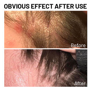 Shampooing antifongique pour le <span class=keywords><strong>psoriasis</strong></span> du <span class=keywords><strong>cuir</strong></span> <span class=keywords><strong>chevelu</strong></span> de marque privée shampooing pour la folliculite à l'acide salicylique shampooing pour la dermatite séborrhéique à l'huile d'arbre à thé - Product Image 3