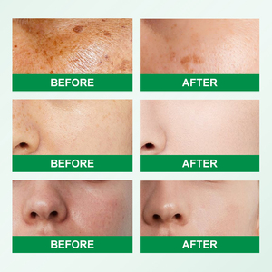 Crème Correctrice Anti-Taches CHIC BEAUTE à la Niacinamide pour l'Hyperpigmentation, Élimination des Taches Solaires, des Taches de Rousseur et des Taches de Vieillesse - Product Image 3