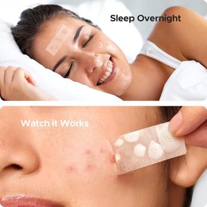 Patchs hydrocolloïdes anti-acné de grande taille, découpables sur mesure ; adaptés aux traitements de l'acné sur le visage, le corps, le front et le dos. - Product Image 1