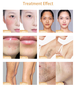 Appareil professionnel de suppression de tatouages par picoseconde et d'épilation IPL – Équipement de beauté professionnel pour le blanchiment de la peau 1064nm 532nm - Product Image 4
