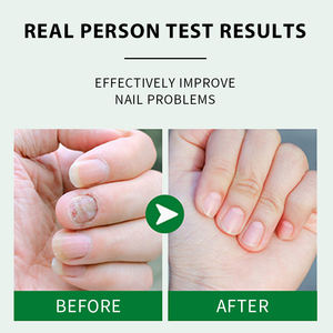 Fórmula natural personalizada superventas para el tratamiento <span class=keywords><strong>de</strong></span> <span class=keywords><strong>hongos</strong></span> en <span class=keywords><strong>las</strong></span> <span class=keywords><strong>uñas</strong></span>, reparación <span class=keywords><strong>de</strong></span> <span class=keywords><strong>uñas</strong></span> <span class=keywords><strong>de</strong></span> jengibre gris, tratamiento <span class=keywords><strong>de</strong></span> suero líquido calmante para el crecimiento <span class=keywords><strong>de</strong></span> <span class=keywords><strong>las</strong></span> <span class=keywords><strong>uñas</strong></span> - Product Image 5