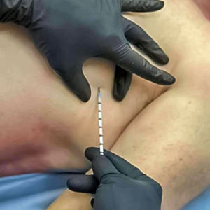 Aiguille de décompression d'urgence thoracique jetable tactique médicale Ifak pour le traitement de la tuberculose pulmonaire - Product Image 4