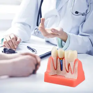 Modelo de implante dentário para educação do paciente, 4 vezes, modelo coroa e ponte para apresentação-rosa