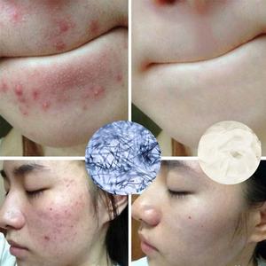 1000G Acne-Porne Gezichtscrème Bleekcrème Voor Donkere Huidvlekkenverwijderaar Private Label - Product Image 6