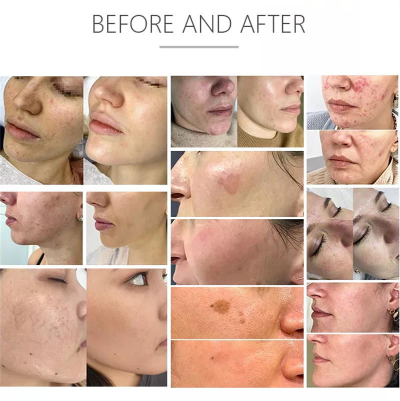 OPT dpl IPL Elight Laser Remove Acne Vascular DPL Fast Hair Removal Painless Ipl Laser Epilator