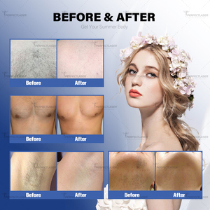 เครื่องรักษาเลเซอร์ Alexandrite มืออาชีพเลเซอร์กำจัดขน1064nm 755nm เลเซอร์อะเล็กซานไดไรต์ชีพจรยาวอ่อนโยน - Product Image 6