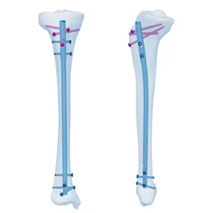 Clavo Intramedular de Bloqueo para Traumatismos de Fémur, Tibia y Húmero - Product Image 6