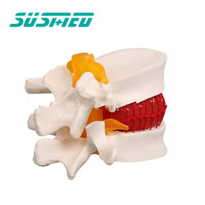 Modèle de démonstration de hernie discale lombaire humaine modèle d'enseignement de l'anatomie de la pathologie discale - Product Image 1