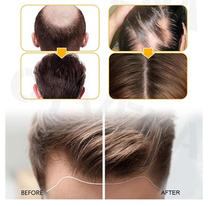 น้ำมันบำรุงผมขิง 100% ช่วยเร่งผมยาวเห็นผลในปี 2023 ป้องกันผมร่วง - Product Image 2