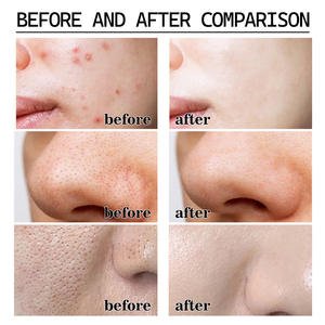 <b>Blackhead</b> <b>Removal</b> Mask Cleanses <b>Blackheads</b> Lightens Pimples Tightens Pores and Controls Oil Smearing for Face - Product Image 5