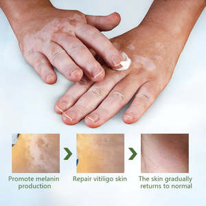 Pommade réparatrice cutanée localisée d'usine OEM pour le traitement des taches blanches, du vitiligo, du <span class=keywords><strong>psoriasis</strong></span> et de la leucoplasie – Fourniture de santé - Product Image 2