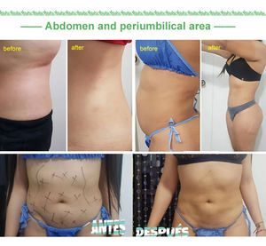 Appareil de <span class=keywords><strong>lipolyse</strong></span> au <span class=keywords><strong>laser</strong></span> diode 1470 nm, raffermissement cutané, liposuccion Vaser, élimination des rides du contour des yeux, lifting endo-<span class=keywords><strong>laser</strong></span> - Product Image 6