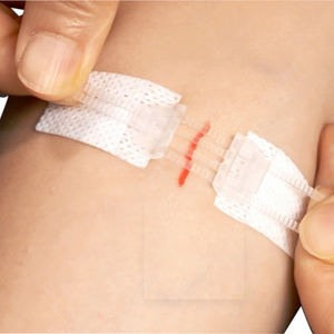 Échantillon gratuit de pansements adhésifs médicaux en forme de papillon avec fermeture à glissière fournisseur d'usine de bandages - Product Image 6