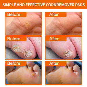 Corn <strong>Plaster</strong> for Feet, <strong>Wart</strong> &amp; Callus Removal, Foot Care Corn Patch - Product Image 3