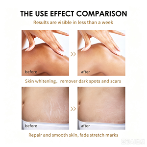 ZLZR Extra Strong Peeling Oil Kojic Acid Exfoliating Oil Brightening Remove Dark Spots Fade Stretch Marks Body Care Oil - Product Image 2