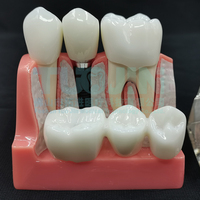 Modèle d'analyse dentaire 4 fois agrandi pour implants, couronnes, bridges, démonstration, modèle amovible, modèle d'enseignement et de formation pour dentistes