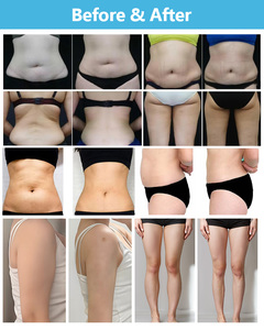 Hot Sale 3 in 1 <b>Cryolipolysis</b> <b>Slimming</b> <b>Machine</b> Body Pain & Weight Loss Equipment Non-Invasive & Painless Therapy <b>Machine</b> - Product Image 5