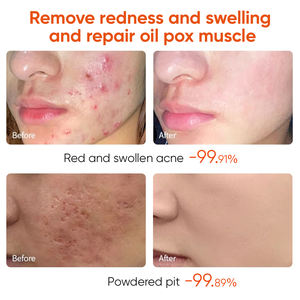 Meilleure Crème Visage Anti-Âge et Anti-Acné Resserre les Pores Hydratante pour Boutons Forte Crème Blanchissante et Éclaircissante pour Taches de Rousseur - Product Image 4