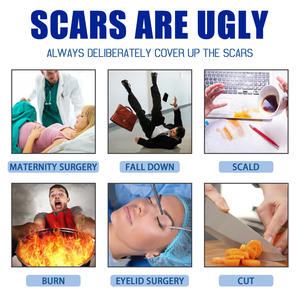 South Moon, recién llegado, acné, espinillas, estrías, crema para eliminar cicatrices para cicatrices viejas en la cara y las piernas, crema para eliminar cicatrices corporales - Product Image 3