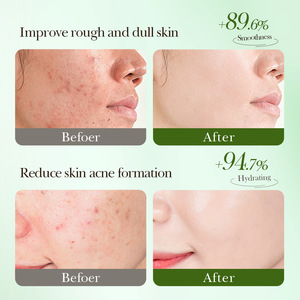 Ensemble de soins à l'acide salicylique pour peaux sujettes à l'acné : masque facial, sérum, nettoyant, contrôle du sébum, soin des pores - Product Image 3