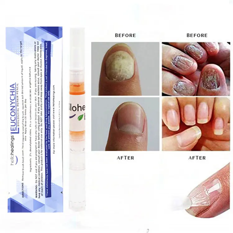 Aangepaste Logo Effectieve Anti Schimmel Hand Nagels Behandeling Care Pen Tool Reparatie Slip Nagel Schimmel Oplossing