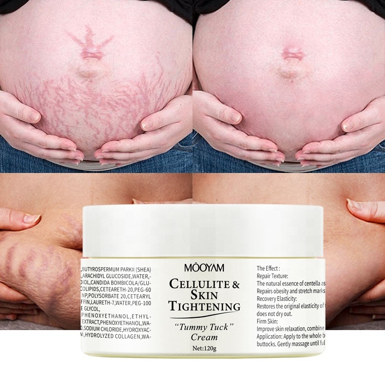 Remove Stretch Marks Cream Anti Wrinkle