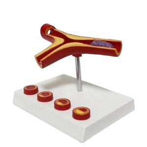 Modèle d'anatomie en PVC <span class=keywords><strong>vasculaire</strong></span> Matériau de haute qualité fait à la main Athériosclérose et thrombose Modèle de <span class=keywords><strong>pathologie</strong></span> des vaisseaux sanguins - Product Image 1