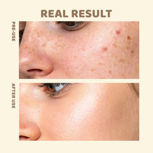 เครื่องกำจัดรูขุมขนและกำจัดสิวหัวดำจากเชื้อไวรัสซาลิไซลิกแอซิด + หมักข้าว - Product Image 3