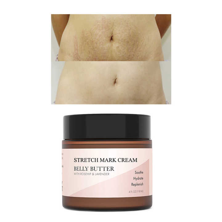 Wholesale Private Label 100% Natural Maternity Skin Care Anti Stretch Marks Removal Cream