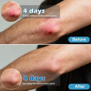 YOJO - Rollo de Parches Hidrocoloides Autoadhesivos, Personalizables en Tamaño y Forma, Esterilizados con Óxido de Etileno, Certificados por la CE, para el Cuidado de Heridas, Quemaduras y Ampollas - Product Image 5