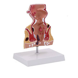 Menselijk Colorectaal Model Rectaal Pathologisch Aambei Model Anale Fistel Anatomisch Model - Product Image 1