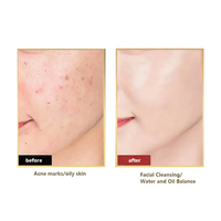 Limpiador Facial Espumoso con 5% de Peróxido de Benzoilo y Ácido Hialurónico, Personalizado, Suave, Reparador, para Piel Sensible con Acné