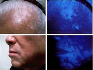 เครื่องวิเคราะห์ผิวหนังด้วยแสงยูวี รุ่น Kernel Woods Lamp KN-9000B สำหรับการตรวจผิวหนังด้วยวิธี Wood Lamp ในสาขาวิชาโรคผิวหนัง - Product Image 3