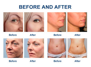 Appareil multifonction 5-en-1 HIFU 7D anti-âge pour lifting du visage et rajeunissement vaginal, avec brosse nettoyante HIFU pour le visage (modèle 2026) - Product Image 6