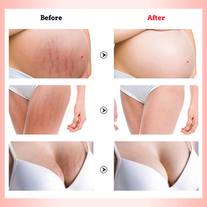 Fórmula herbal natural omy Lady, eliminador permanente de cicatrices de acné, crema antiestrías, personalizado gratis - Product Image 5